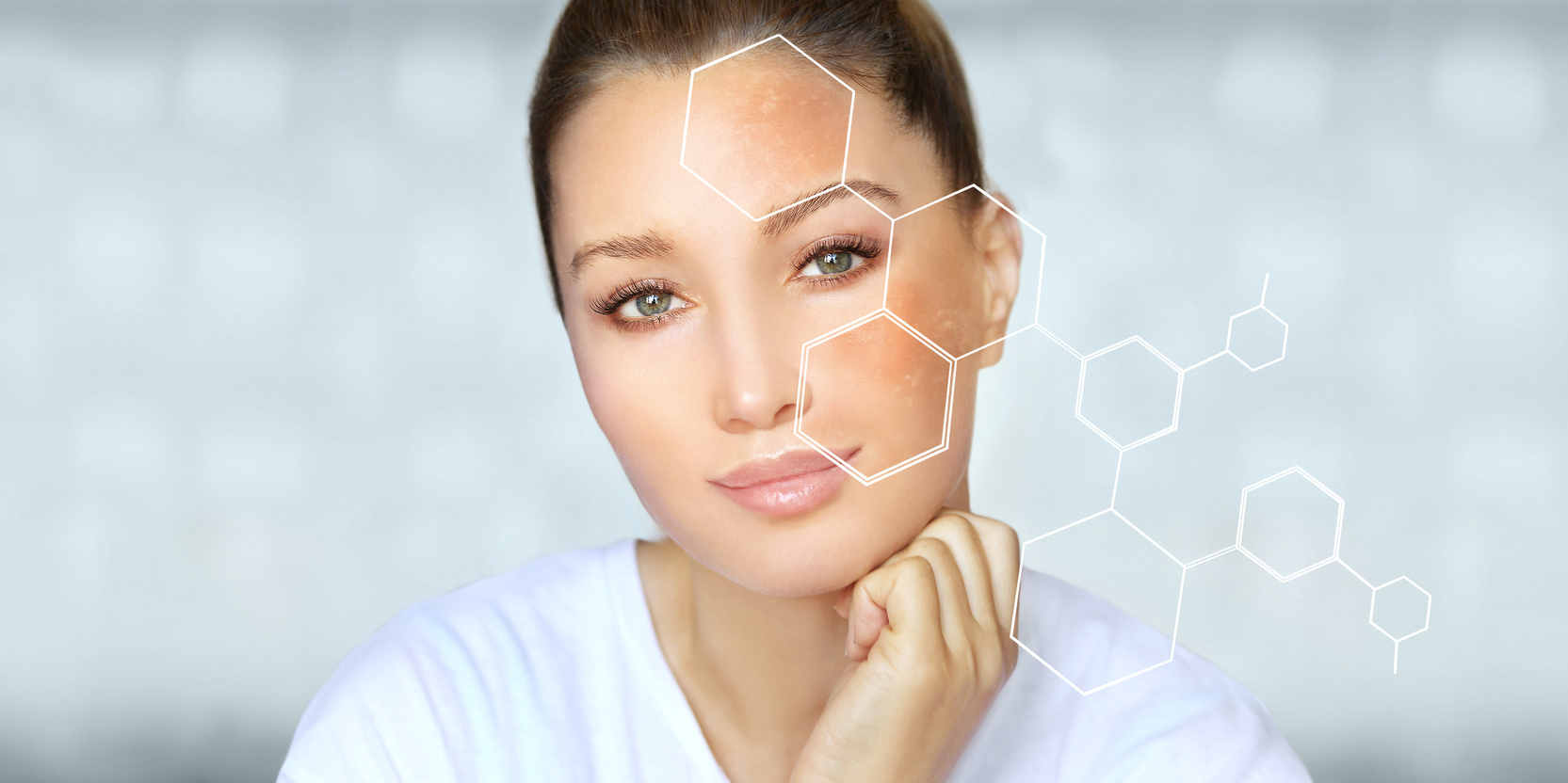 Dark spots, freckles,hyperpigmentation(melasma or chloasma),concept- skin lightening, skin whitening, Skin Brightening