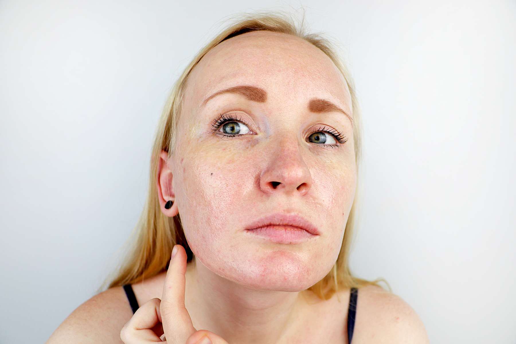 Oily and problem skin. Portrait of a blonde girl with acne, oily skin and pigmentation